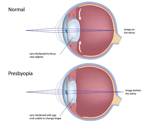 Presbyopia anatomy - normal vs presbyopic lens